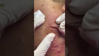 Best Pimple Popping Videos 02 beautiful blackheads sacdepspa [upl. by Althee646]