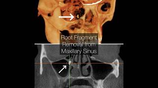 Removing a Root from the Maxillary Sinus [upl. by Airot]