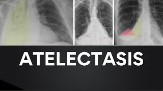 Atelectasis Chest Xrays with Overlays [upl. by Liu117]