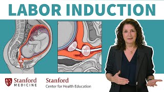 What is labor induction OBGYN answers 5 common questions about inducing labor  Stanford [upl. by Aihsenak415]