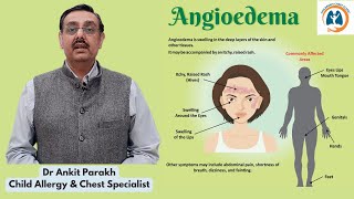 Angioedema in children Symptoms Diagnosis amp Treatment Dr Ankit Parakh Allergy Specialist [upl. by Alikee]