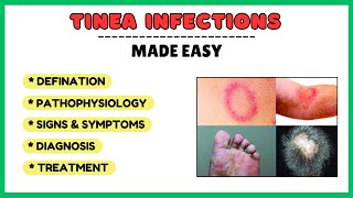 Tinea infection fungal skin infection types of tinea pathophysiology diagnosis treatment [upl. by Ecal]