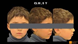 Treatment of CL III malocclusions in pediatric patients PLANAS DIRECT TRACKS FOR EARLY CORSS BITE [upl. by Fonsie270]