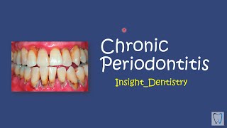 Chronic Periodontitis [upl. by Ayaj492]