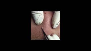 Part 3 Have you got bored of these tiny blackhead extractions Pimple removal [upl. by Lleze]