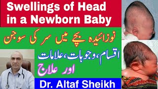 Head Swellings in Newborn Baby  Caput Succedaneum and Cephalohematoma TreatmentDrAltafSheikh [upl. by Cad]