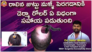 Derma Roller For Hair Growth  డెర్మా రోలర్ ఉపయోగించే విధానం  DrJohn Watts  Trichos [upl. by Anoirtac644]