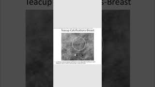 Breastteacup calcificationradiology inicet neetpg [upl. by Stesha]