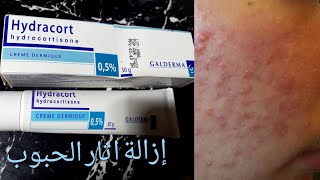 احسن مرهم لعلاج اثار حب شباب وتصبغات واحمرار جلد الفطرياتHydracort [upl. by Premer240]