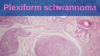 Plexiform Schwannoma  Pathology mini tutorial [upl. by Silda]