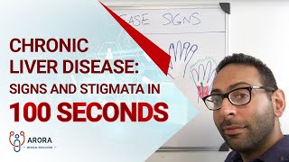 Chronic Liver Disease Signs and Stigmata in 100 seconds [upl. by Adnotal]