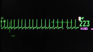 atrial fibrillation with rapid ventricular rate on an ECG heart monitor [upl. by Enwahs]