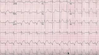 Q Wavein STEMI NSTEMI normal amp pathological [upl. by Nerok]