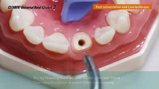 How to with UBQ 2 Post Cementation and Core Build Up [upl. by Templeton]