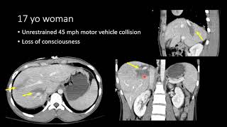 Blunt Abdominal Trauma Part 2 Liver Injury [upl. by Tnirb780]