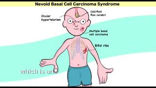 Gorlin syndrome nevoid basal cell carcinoma syndrome  Mnemonic  easy learning [upl. by Deth]