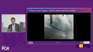 Transformative imaging in the clinical pathway of transcatheter tricuspid valve interventions [upl. by Ihteerp]