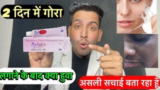 Melas cream गोरापन करगी  Melas cream असली सचाई  Use करने के बाद क्या हुवा  melas cream use [upl. by Notsirhc]