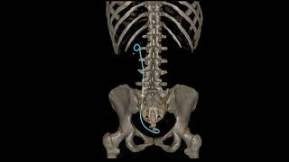 Reconstruccion 3D abdomen pelvis con Cateter doble J en riñon tomografo GE ACT Revolution [upl. by Pastelki]