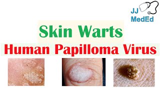 Overview of Skin Warts Verrucae  What Causes Them Who Gets Them  Subtypes and Treatment [upl. by Keily]