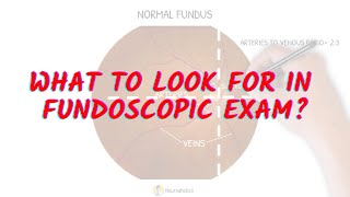 What to look for in fundoscopic exam Neuroaholics [upl. by Ima]