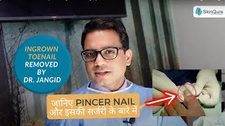 Ingrown Toe nail Removal by Dr Jangid  Nail surgery in Delhi  Nail treatments at SkinQure [upl. by Cornelie766]