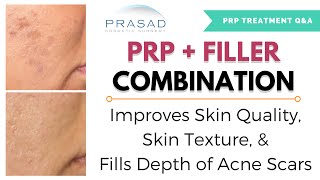 Acne Scar Treatment  Combining of PRP for Improved Skin Texture and Filler for Elevation [upl. by Ardnaet]