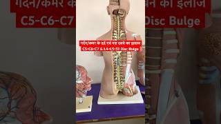 Cervical Problem amp Lower Back Pain Treatment shorts sciatica neckpain [upl. by Ardis]