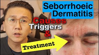 Seborrhoeic Dermatitis  Causes Triggers amp Treatment Options [upl. by Catha]