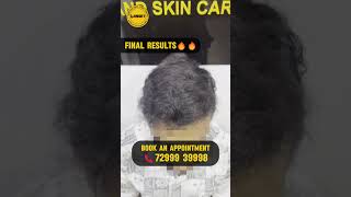 TOP HAIR TRANSPLANT RESULTS 2024 LaHNS hairtransplant MahinTN hairtransplantresults hairstyle [upl. by Freytag]