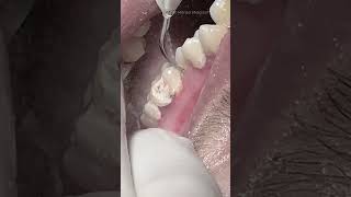 Deep cleaning teeth procedure video satisfying [upl. by Ajan148]