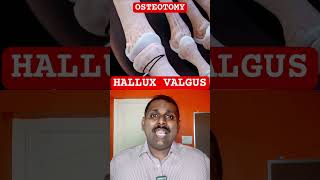 HALLUX VALGUS procedure [upl. by Delainey]