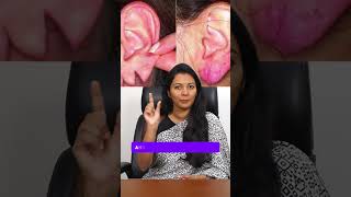 Ear Lobe Correction  DrCharumathy Explains [upl. by Ennaeerb429]