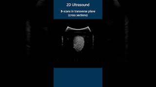 2D Ultrasound Bscans  Example 2 [upl. by Sert]