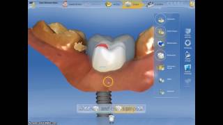 Coroane dentare si bont protetic realizate digital intro singura sedinta cu Cerec CadCam [upl. by Lebisor]