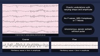 Ventricular Fibrillation ECG [upl. by Marwin]