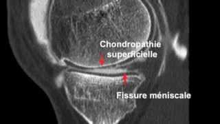 Chondropathie fémorotibiale et Arthroscanner [upl. by Robby]