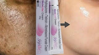 SkinLite Cream Review 2023  Uses Benifits and SideEffects of SkinLite Cream Skin Whitening Cream [upl. by Teddi]