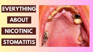 Nicotinic Stomatitis Explained Causes Symptoms and Treatment Options  InDepth Lecture [upl. by Tiffa]