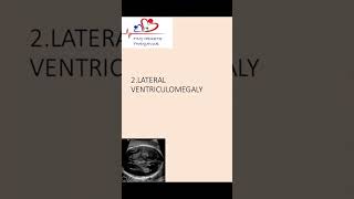 Lateral ventriculomegaly of fetal brain on antenatal scan ventriculomegaly [upl. by Grace]