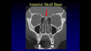 Imaging of the Paranasal Sinuses 1 [upl. by Carena]