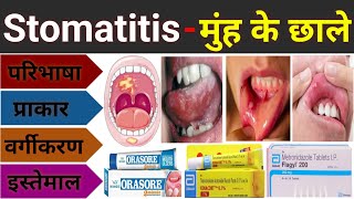 Stomatitis  मुंह के छाले का इलाज  Mouth Ulcer Treatment  Stomatitis In Hindi Muh Ke Chale Ka Ilaj [upl. by Mackay]