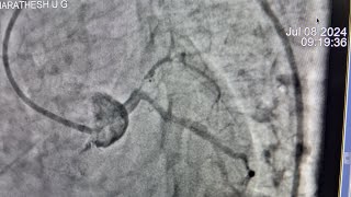 LM LAD stenting ostial LAD 100LAD slowflowsevere LVDcardiogenic shock [upl. by Kathye]