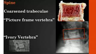 Imaging Paget disease of bone [upl. by Noivert]