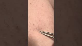 Closeup Ingrown Hair extraction blackheads ingrownhair oddlysatisfying hairextraction [upl. by Casilde]