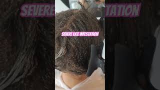 Lice Infestation l lice removal l small business explore hair lice hairvideo [upl. by Ceciley398]