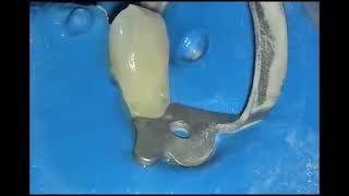 Aquacare 아쿠아케어 Dental Air Abrasion with Aquacut Kinetic Preparation by Grzegorz Witkowski [upl. by Litnahc]