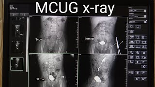 MCUGVCUG xRay procedure micturating cystourethrogram  MCUGVCUG test in Radiology [upl. by Ledniahs]