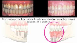 Implants dentairesampEdentement total mandibulaire resorbéImplantsampResorbed edentulous mandible [upl. by Dnarb874]