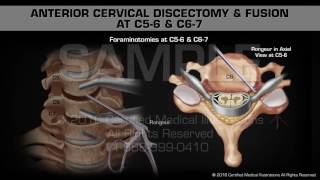 Anterior Cervical Discectomy amp Fusion at C56 amp C67 [upl. by Roybn]